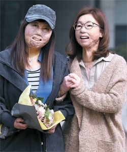 战胜全身烧伤 入学梨花女子大学的在中同胞崔丽娜